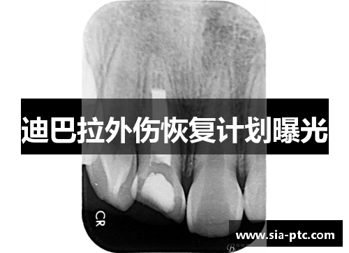 迪巴拉外伤恢复计划曝光